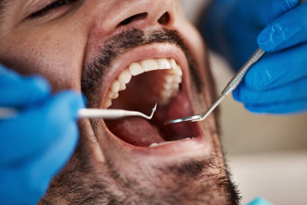 Emergency Dental Filling Replacement in KS